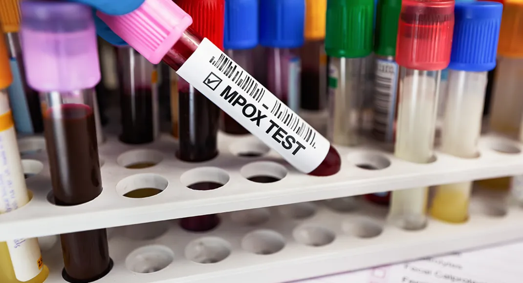 Mpox returns with mutation threat Are Indian vaccine makers Serum Institute ready