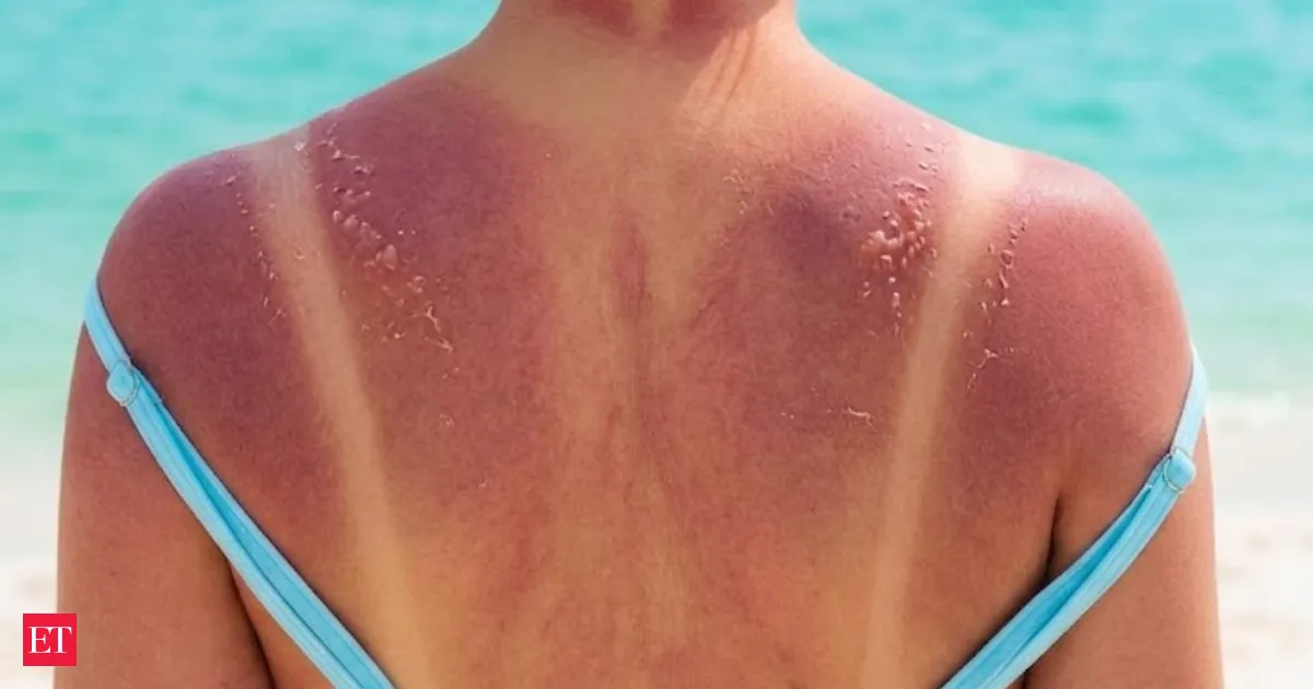 Sunburn mystery solved as scientists pinpoint RNA damage over DNA triggering fast pain